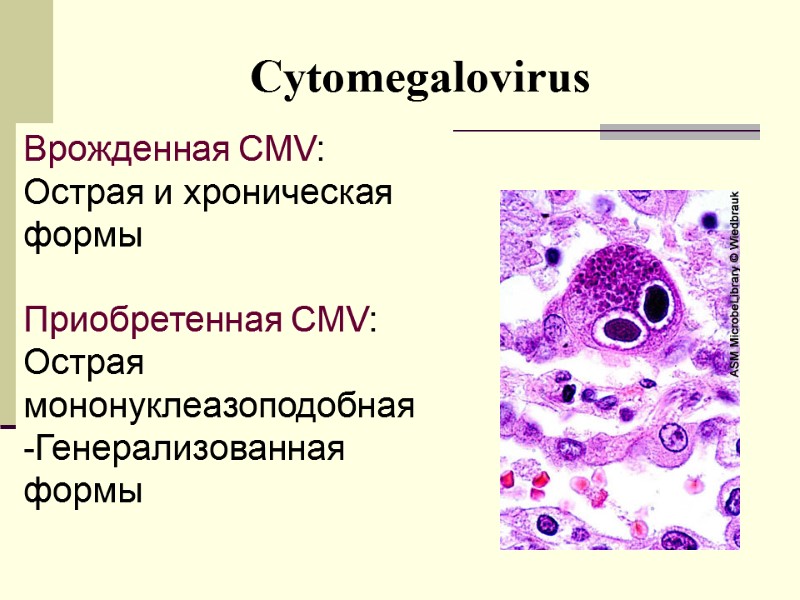 Сytomegalovirus Врожденная CMV: Острая и хроническая формы  Приобретенная CMV: Острая мононуклеазоподобная -Генерализованная 
